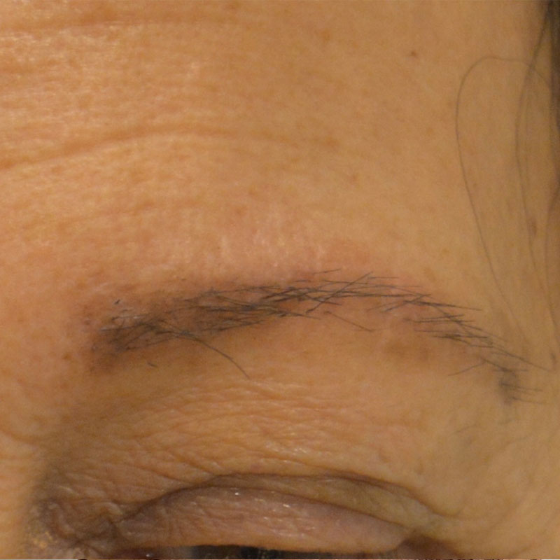 Imagen después (Caso facial 1)