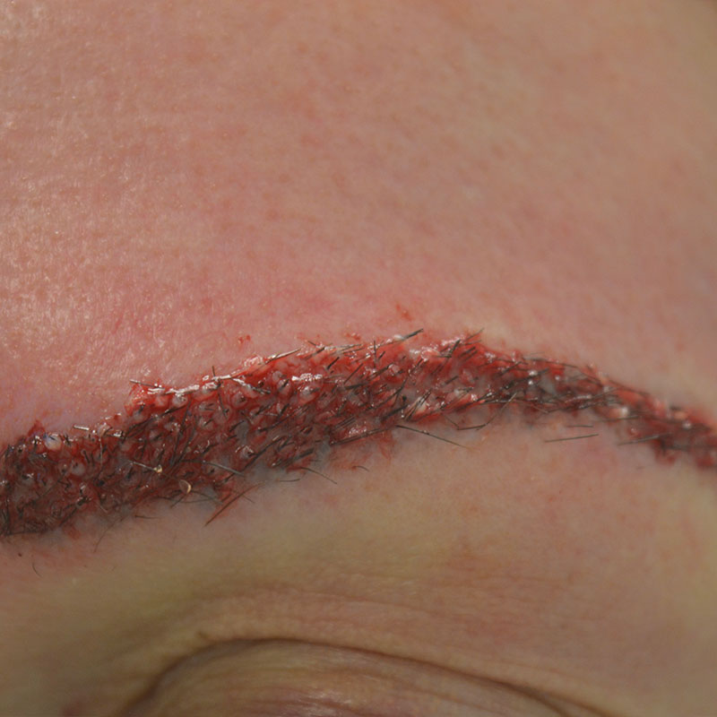 Imagen después (Caso facial 2)